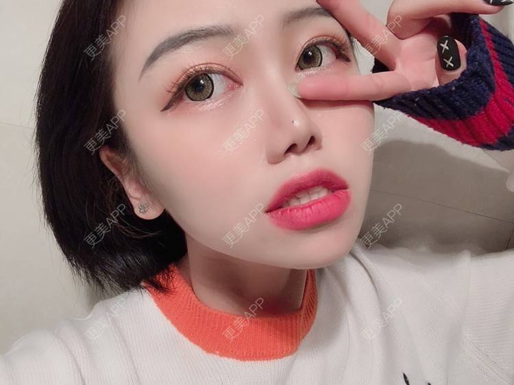 更美 - 更美用户DPh4BlmoOY的M唇成形经验 | M唇成形
