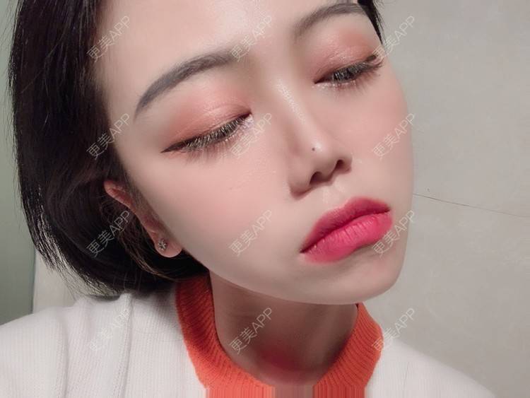 更美 - 更美用户DPh4BlmoOY的M唇成形经验 | M唇成形