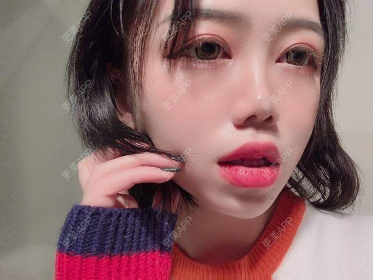 更美 - 更美用户DPh4BlmoOY的M唇成形经验 | M唇成形