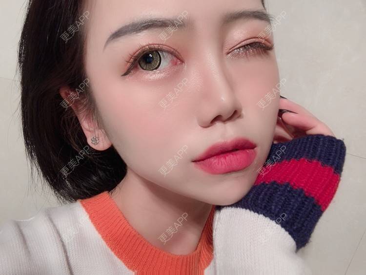 更美 - 更美用户DPh4BlmoOY的M唇成形经验 | M唇成形