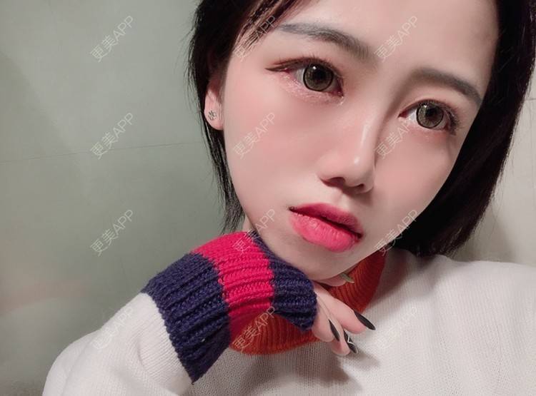 更美 - 更美用户DPh4BlmoOY的M唇成形经验 | M唇成形