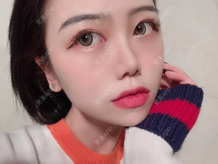 更美 - 更美用户DPh4BlmoOY的M唇成形经验 | M唇成形