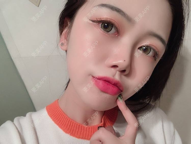 更美 - 更美用户DPh4BlmoOY的M唇成形经验 | M唇成形