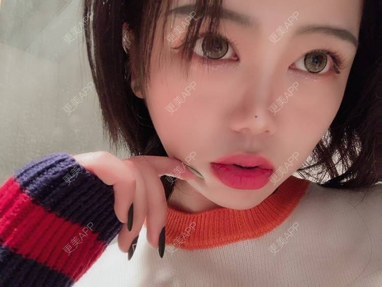 更美 - 更美用户DPh4BlmoOY的M唇成形经验 | M唇成形