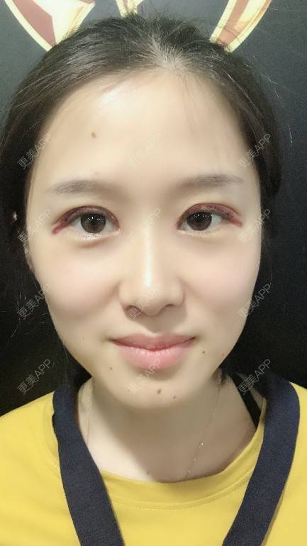 薇薇ww的全切双眼皮日记