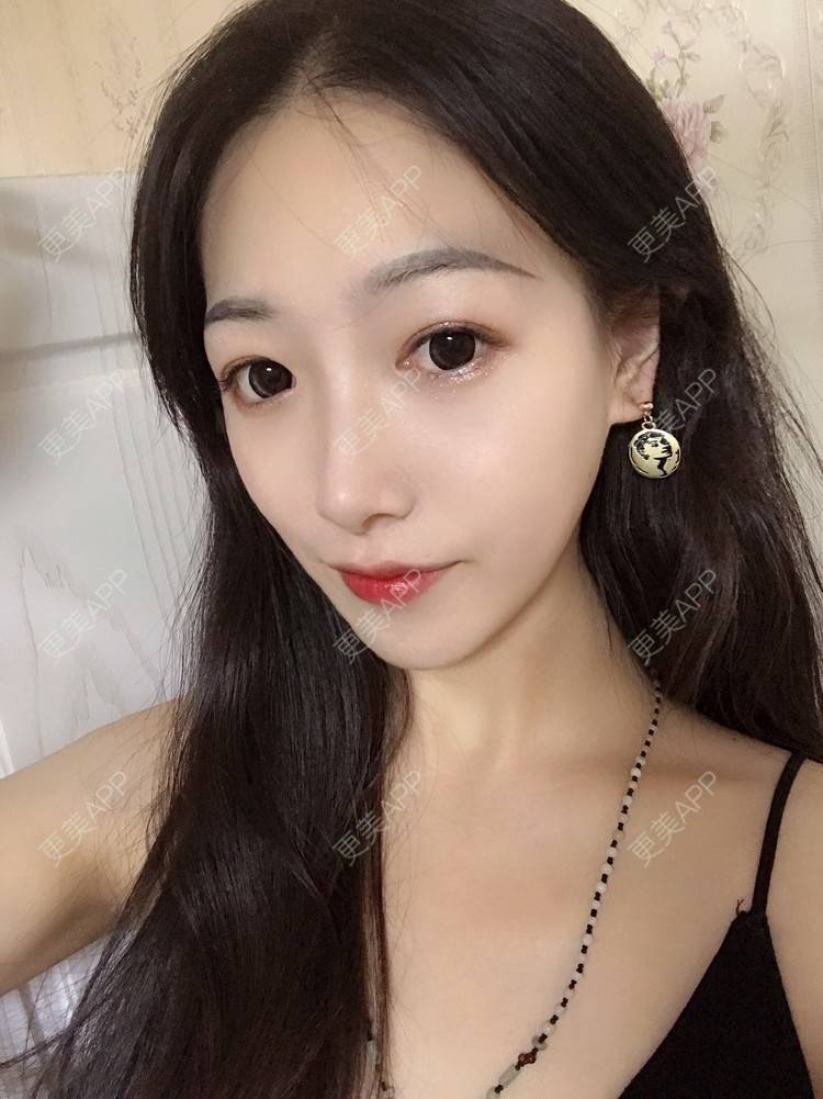 更美 - 更美用户RhEWOOeBRJ的玻尿酸下巴经验 | 玻尿酸下巴 | 重庆