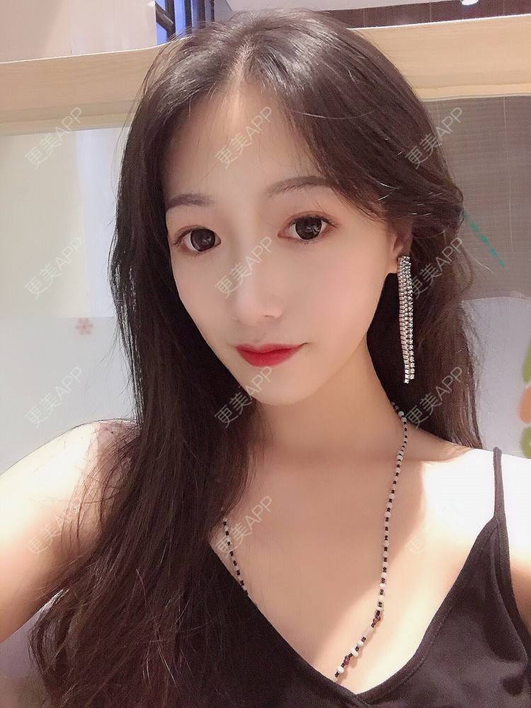 更美 - 更美用户RhEWOOeBRJ的玻尿酸下巴经验 | 玻尿酸下巴 | 重庆