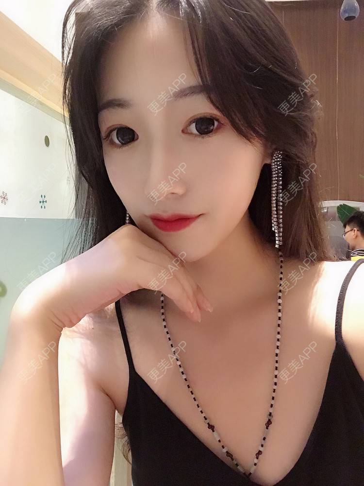 更美 - 更美用户RhEWOOeBRJ的玻尿酸下巴经验 | 玻尿酸下巴 | 重庆