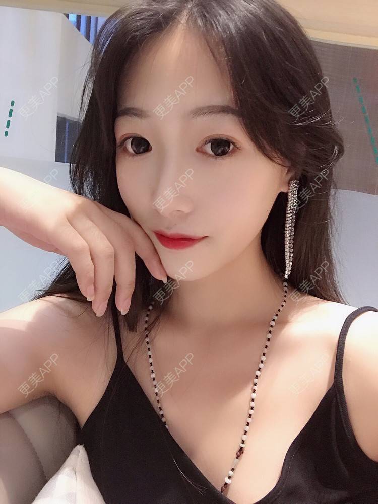 更美 - 更美用户RhEWOOeBRJ的玻尿酸下巴经验 | 玻尿酸下巴 | 重庆