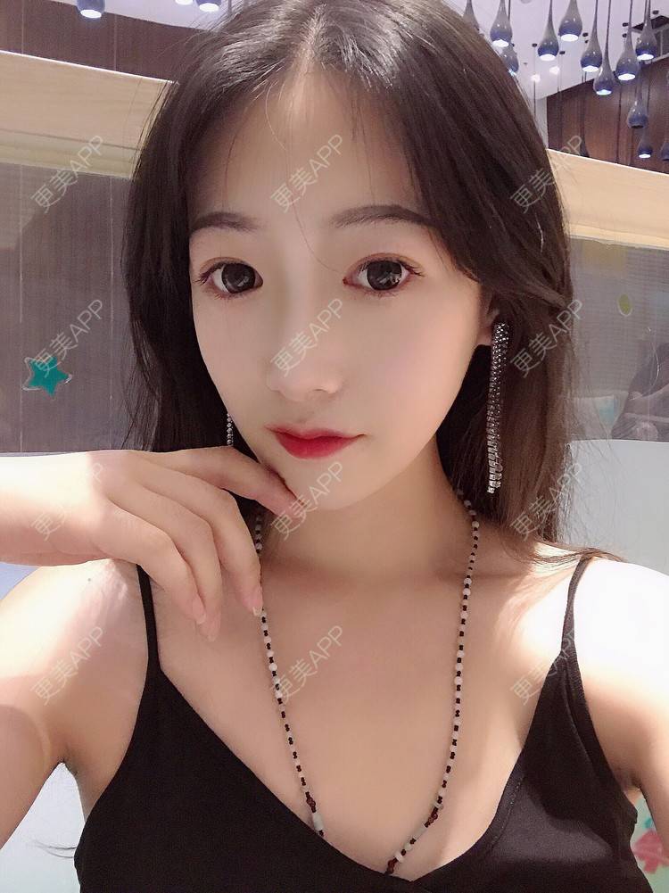 更美 - 更美用户RhEWOOeBRJ的玻尿酸下巴经验 | 玻尿酸下巴 | 重庆