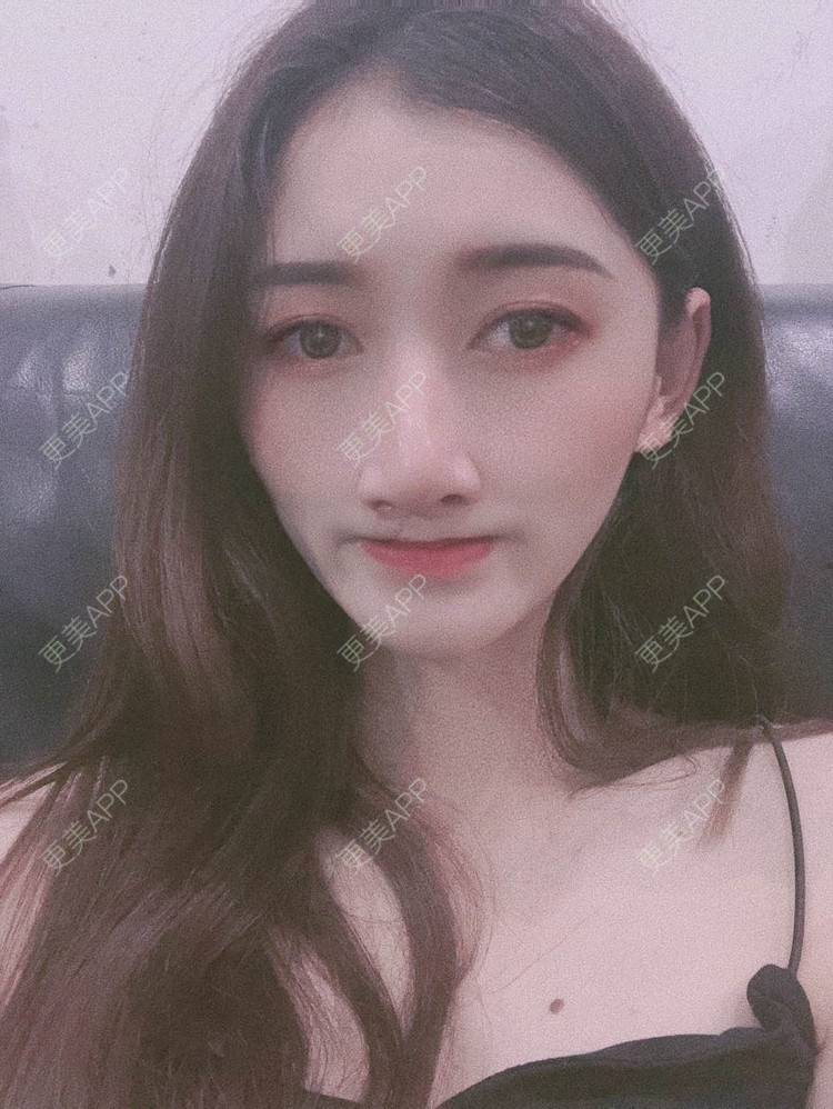 更美 - 最美的期待i的鼻形态修复经验 | 广州 | 鼻形态修复