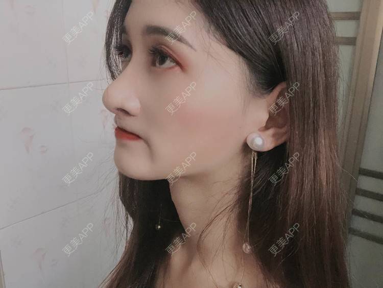 更美 - 最美的期待i的鼻形态修复经验 | 广州 | 鼻形态修复