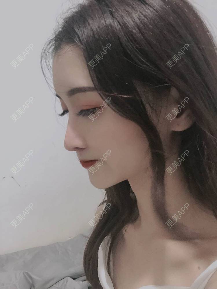 更美 - 最美的期待i的鼻形态修复经验 | 广州 | 鼻形态修复