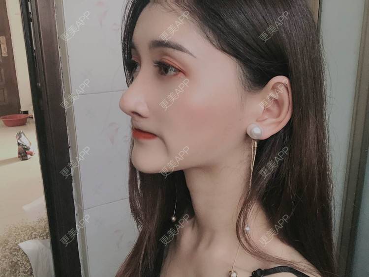 更美 - 最美的期待i的鼻形态修复经验 | 广州 | 鼻形态修复