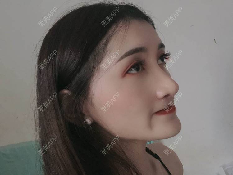 更美 - 最美的期待i的鼻形态修复经验 | 广州 | 鼻形态修复