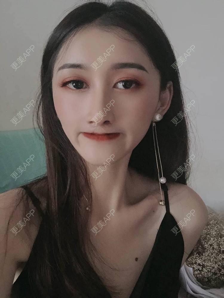 更美 - 最美的期待i的鼻形态修复经验 | 广州 | 鼻形态修复