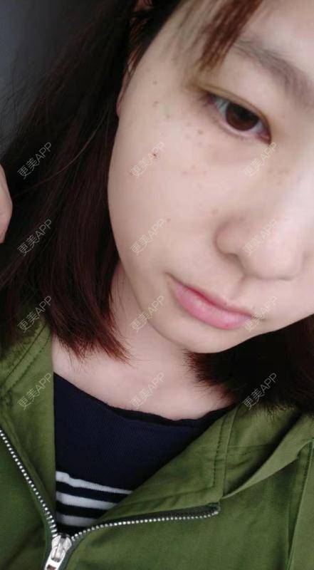 更美 - 啦啦啦得到的皮秒激光经验 | 皮秒激光