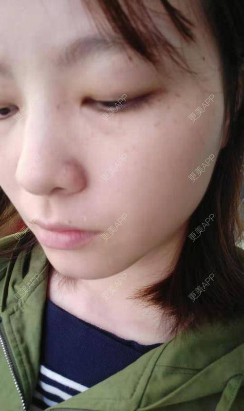 更美 - 啦啦啦得到的皮秒激光经验 | 皮秒激光