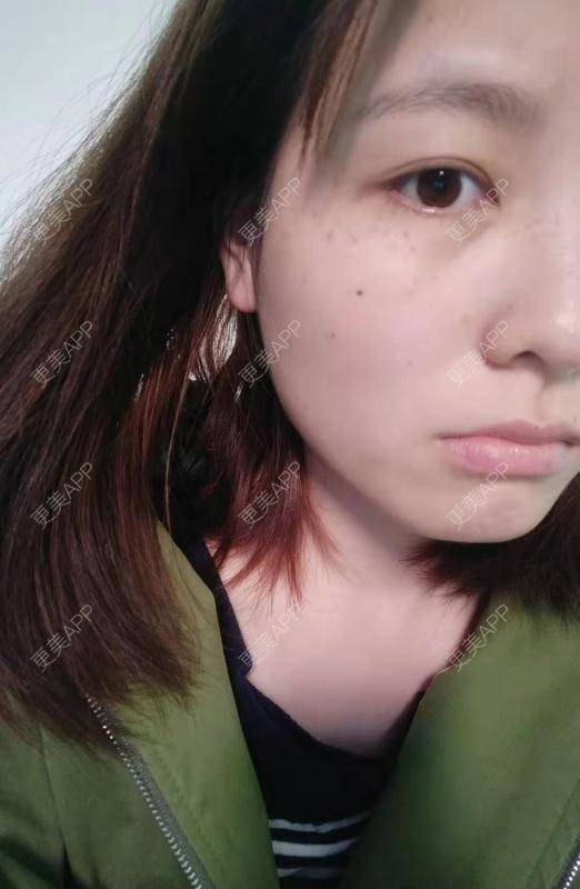更美 - 啦啦啦得到的皮秒激光经验 | 皮秒激光