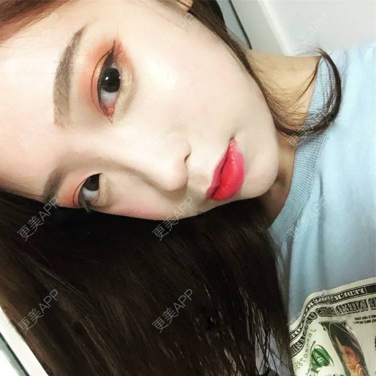 更美 - 更美用户SIiWdJ0xDj的眼部多项经验 | 眼部多项 | 视频日记 | 佛山