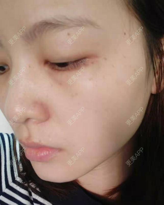 更美 - 啦啦啦得到的皮秒激光经验 | 皮秒激光