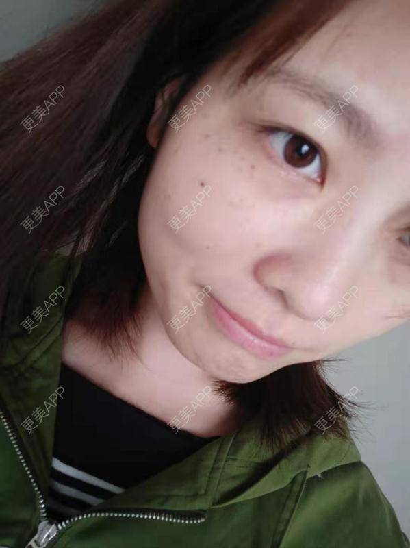更美 - 啦啦啦得到的皮秒激光经验 | 皮秒激光