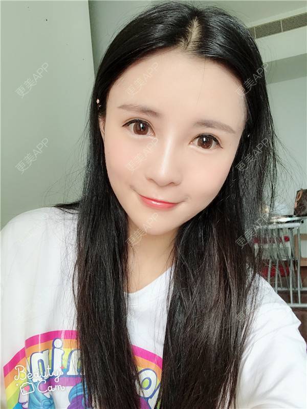 更美 - 更美用户kGC3Vv1XSZ的祛眼袋经验 | 眶隔脂肪释放 | 祛眼袋 | 内切去眼袋 | 重庆