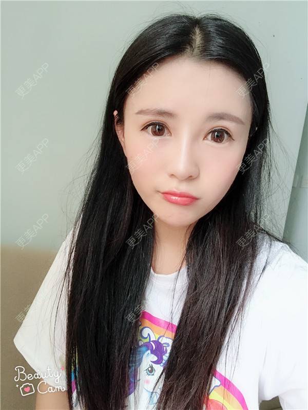 更美 - 更美用户kGC3Vv1XSZ的祛眼袋经验 | 眶隔脂肪释放 | 祛眼袋 | 内切去眼袋 | 重庆