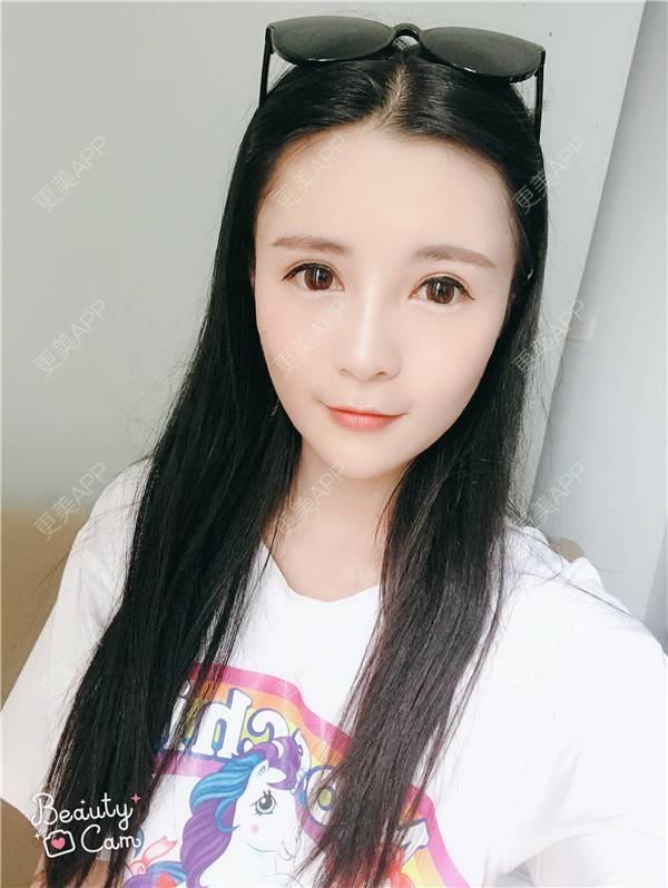 更美 - 更美用户kGC3Vv1XSZ的祛眼袋经验 | 眶隔脂肪释放 | 祛眼袋 | 内切去眼袋 | 重庆