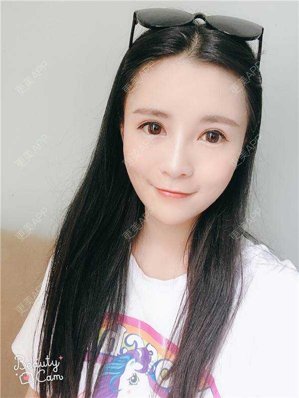 更美 - 更美用户kGC3Vv1XSZ的祛眼袋经验 | 眶隔脂肪释放 | 祛眼袋 | 内切去眼袋 | 重庆