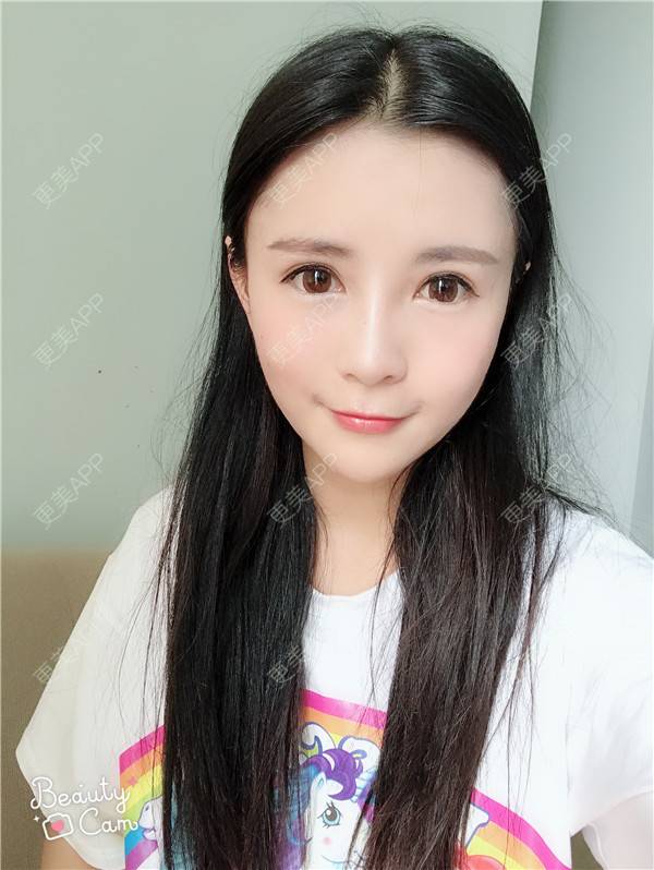更美 - 更美用户kGC3Vv1XSZ的祛眼袋经验 | 眶隔脂肪释放 | 祛眼袋 | 内切去眼袋 | 重庆