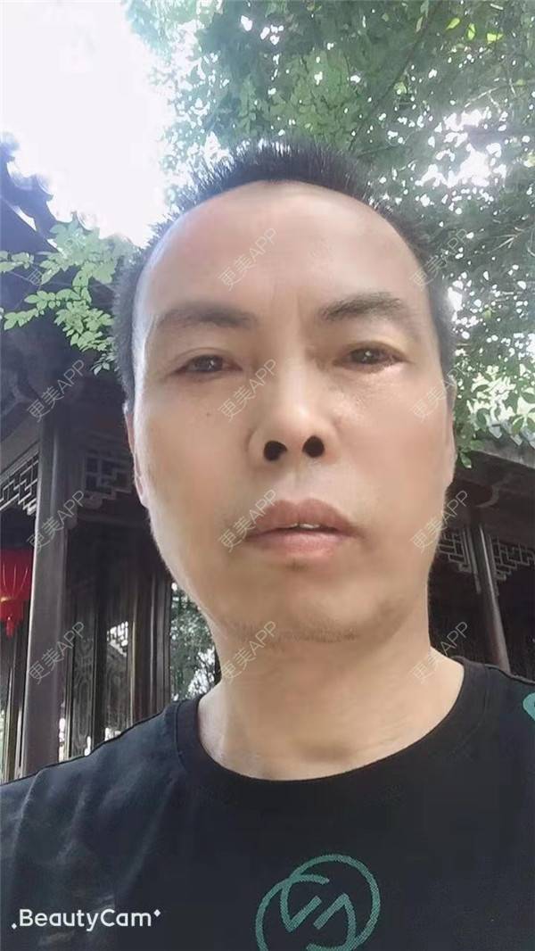 更美 - 更美用户IG0lQLfUjW的外切去眼袋经验 | 杭州 | 外切去眼袋