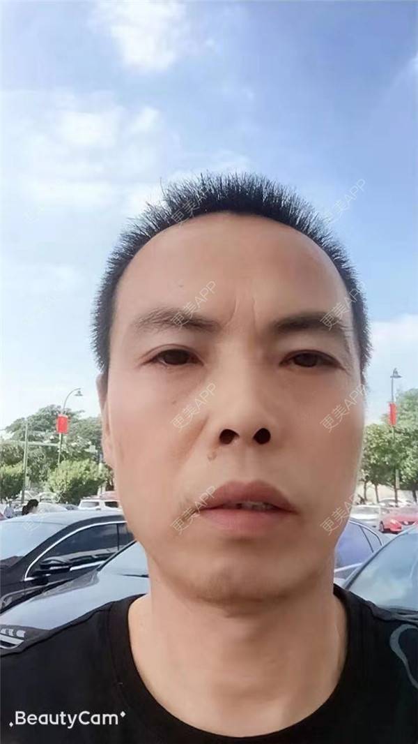 更美 - 更美用户IG0lQLfUjW的外切去眼袋经验 | 杭州 | 外切去眼袋