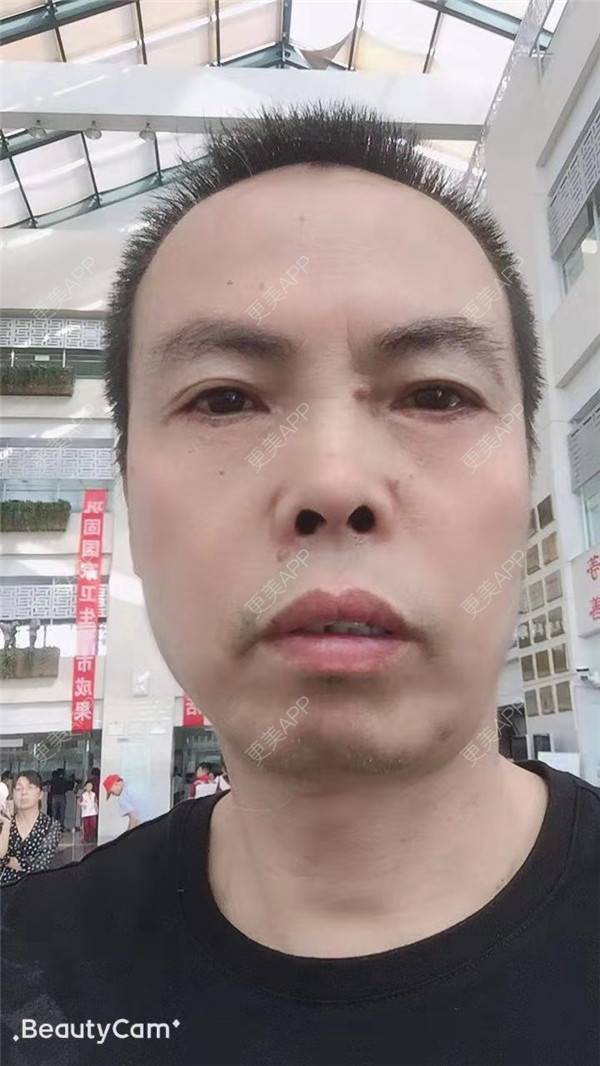 更美 - 更美用户IG0lQLfUjW的外切去眼袋经验 | 杭州 | 外切去眼袋