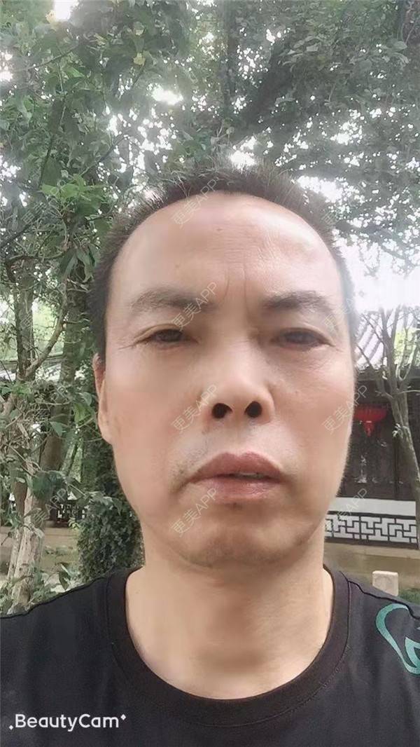 更美 - 更美用户IG0lQLfUjW的外切去眼袋经验 | 杭州 | 外切去眼袋