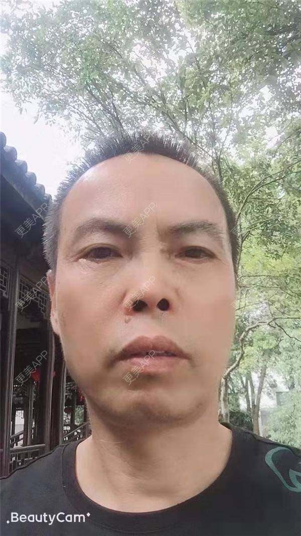 更美 - 更美用户IG0lQLfUjW的外切去眼袋经验 | 杭州 | 外切去眼袋