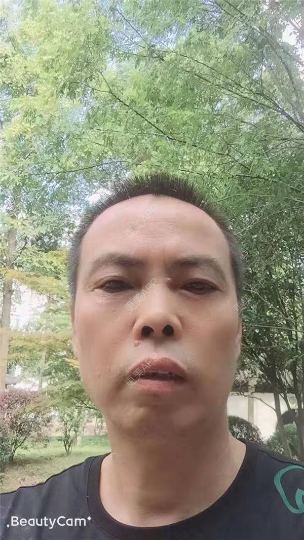 更美 - 更美用户IG0lQLfUjW的外切去眼袋经验 | 杭州 | 外切去眼袋