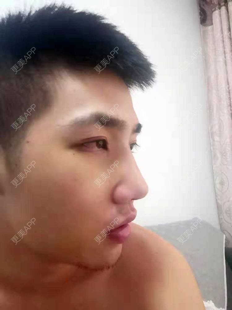 更美 - 仰望ooo的驼峰鼻矫正经验 | 北京 | 视频日记 | 驼峰鼻矫正
