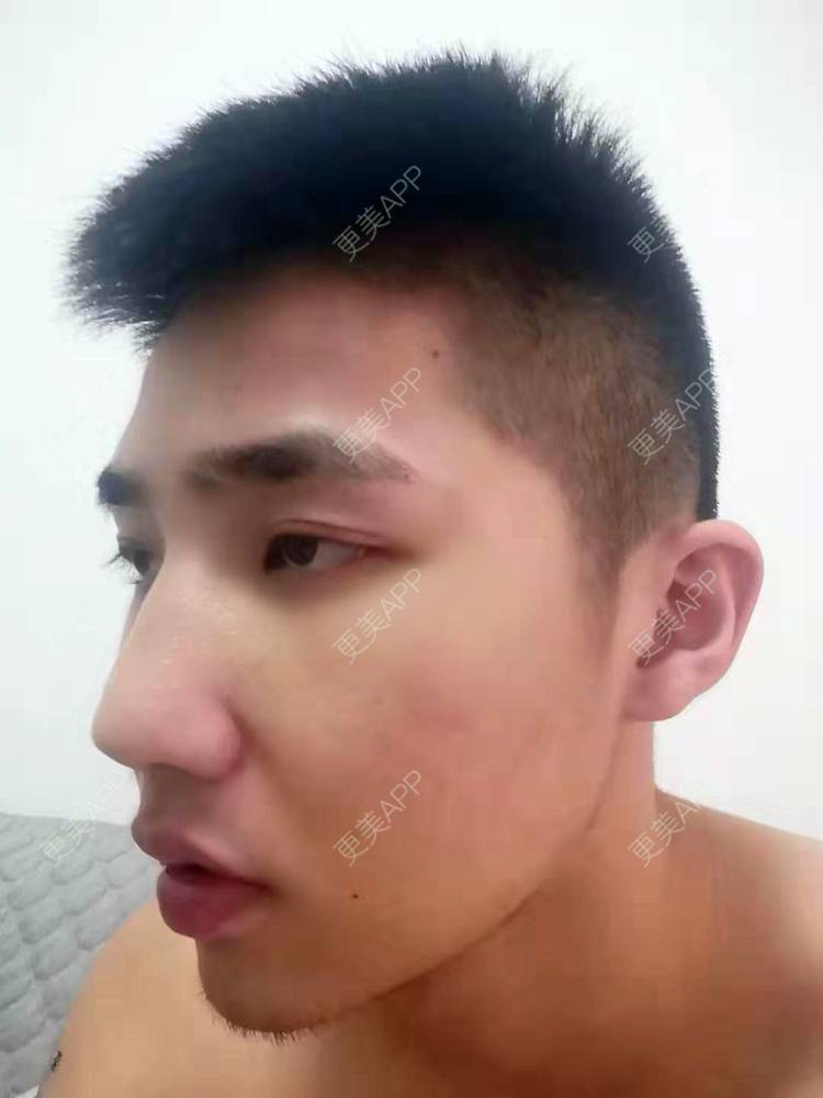 更美 - 仰望ooo的驼峰鼻矫正经验 | 北京 | 视频日记 | 驼峰鼻矫正