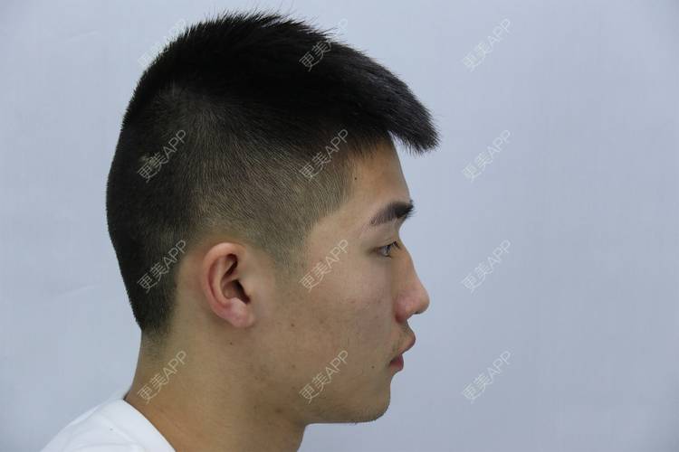 更美 - 仰望ooo的驼峰鼻矫正经验 | 北京 | 视频日记 | 驼峰鼻矫正