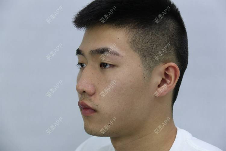 更美 - 仰望ooo的驼峰鼻矫正经验 | 北京 | 视频日记 | 驼峰鼻矫正