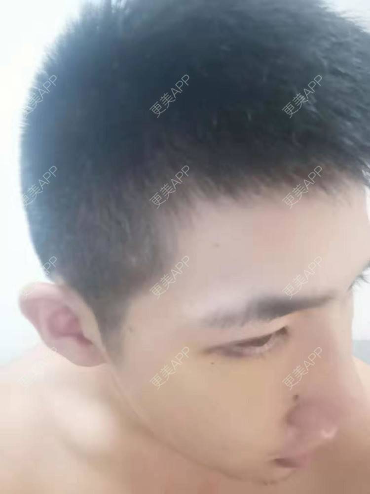 更美 - 仰望ooo的驼峰鼻矫正经验 | 北京 | 视频日记 | 驼峰鼻矫正