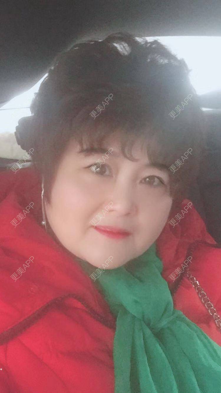 更美 - 更美用户K65AGrOxl2的内切去眼袋经验 | 内切去眼袋 | 成都