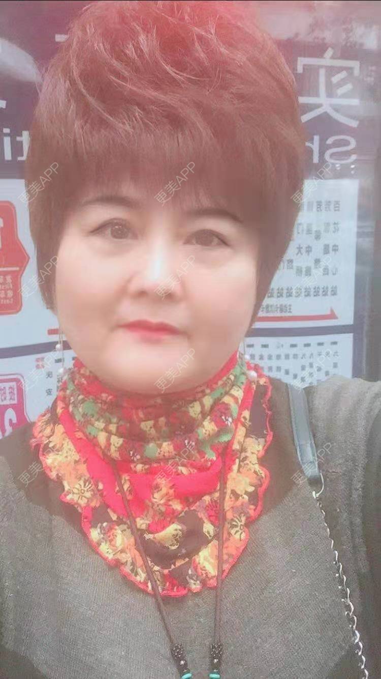 更美 - 更美用户K65AGrOxl2的内切去眼袋经验 | 内切去眼袋 | 成都