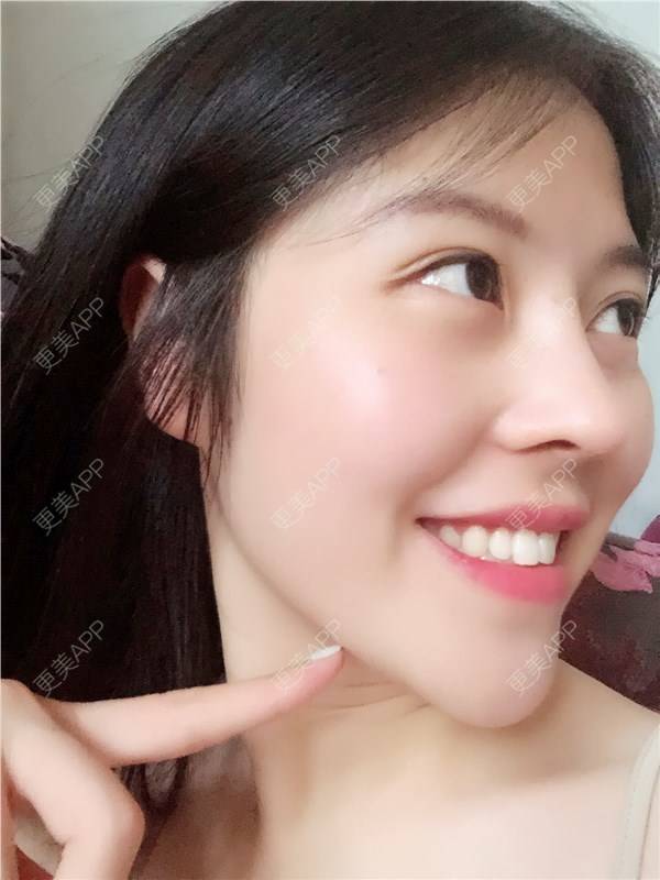 三姐看这里的肋软骨隆鼻日记