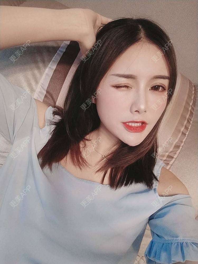 更美 - Daisy11的自体脂肪全面部填充经验 | 自体脂肪全面部填充 | 视频日记 | 重庆