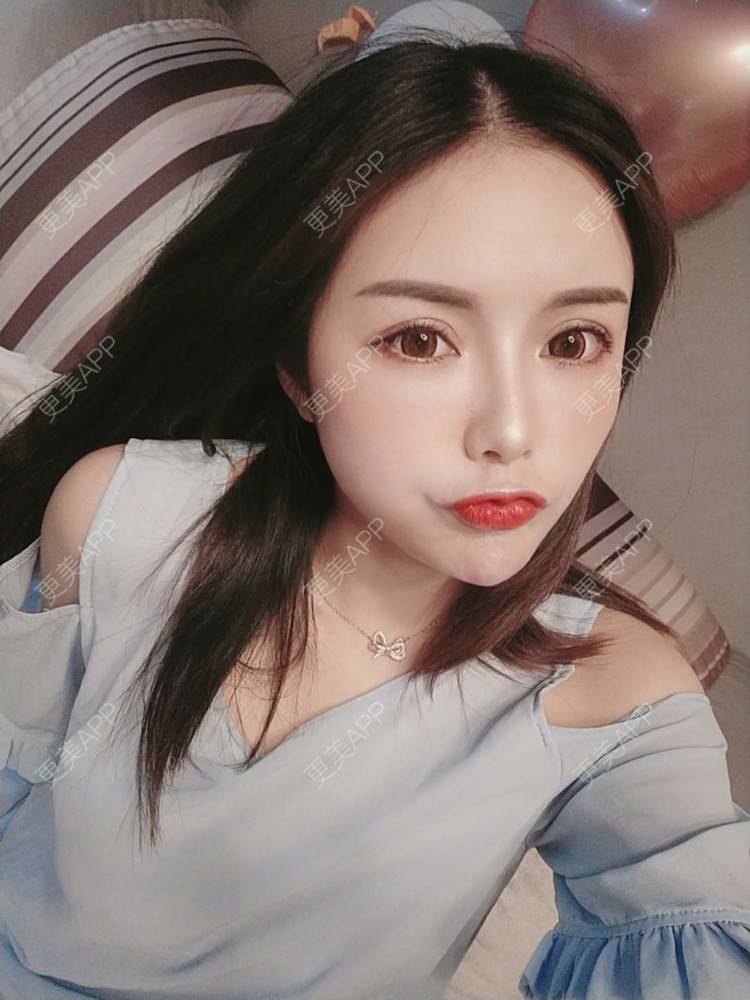 更美 - Daisy11的自体脂肪全面部填充经验 | 自体脂肪全面部填充 | 视频日记 | 重庆