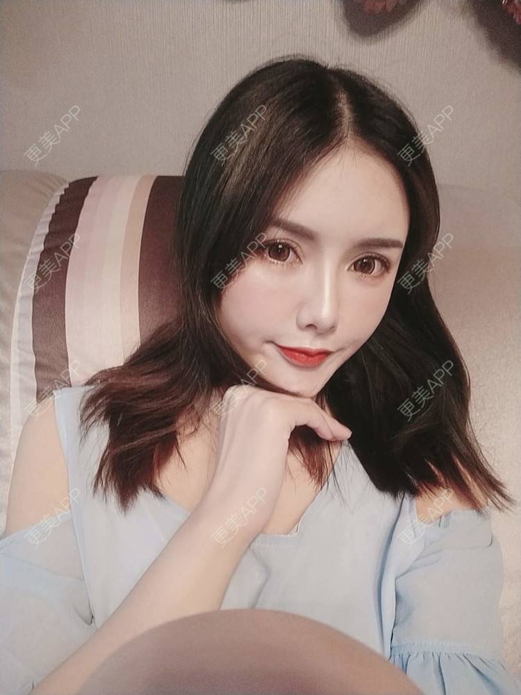 更美 - Daisy11的自体脂肪全面部填充经验 | 自体脂肪全面部填充 | 视频日记 | 重庆