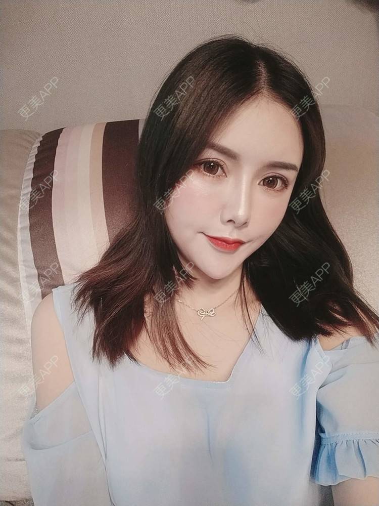 更美 - Daisy11的自体脂肪全面部填充经验 | 自体脂肪全面部填充 | 视频日记 | 重庆