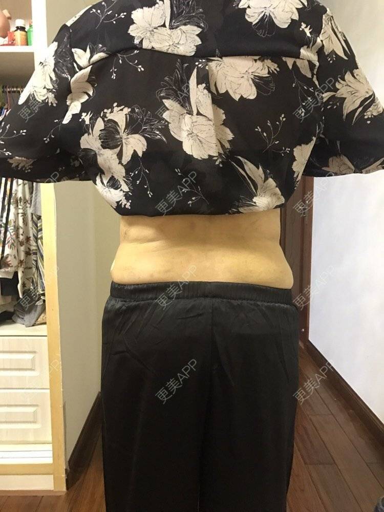 更美用户4brktqr2jo的腰腹吸脂日记